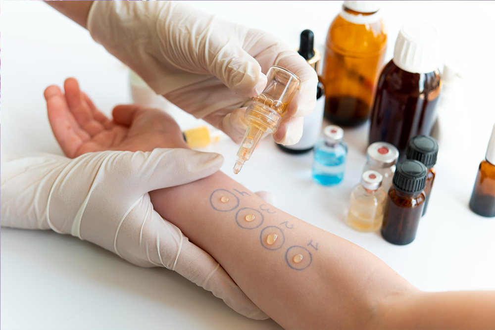 Moleküler Alerji Testi (ALEX II) ve Çocuk Alerji Testi Nedir?